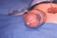 erosion of implant through pee hole.gif