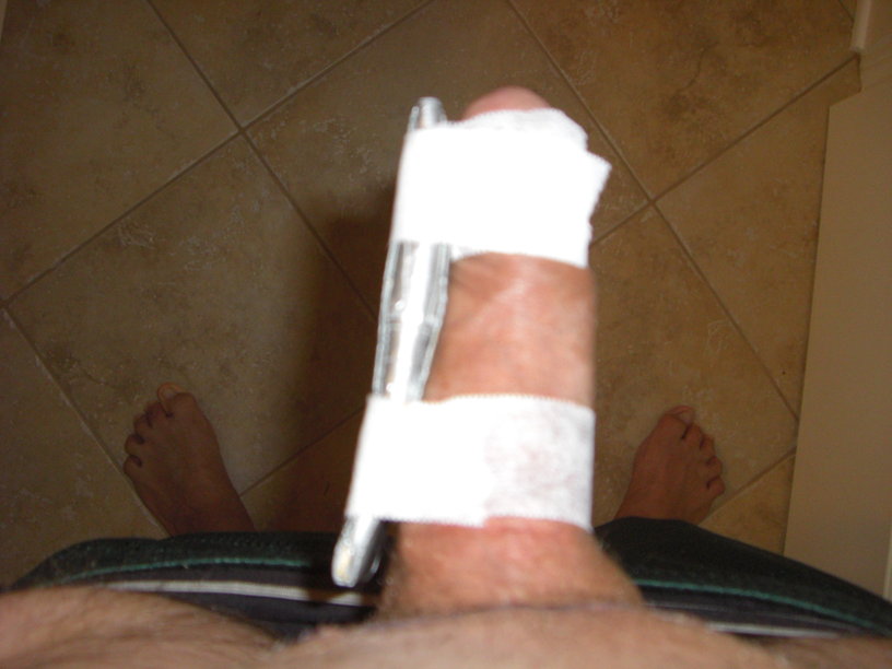 my homemade dick splint.jpg