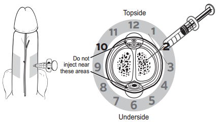 penile_injection_therapy-fig_3-en (1).png